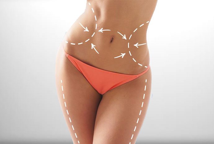 liposuction